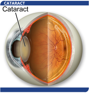 http://clearly.com/images/cataract3.jpg